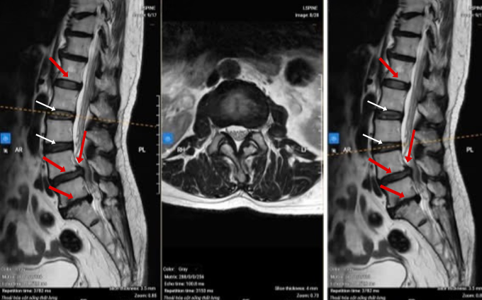AI hỗ trợ bác sĩ mổ cột sống chính xác giảm nguy cơ liệt 1 Hình MRI cột sống cho thấy bà Nga thoát vị đĩa đệm và tổn thương ở nhiều đốt sống. Ảnh: Bệnh viện Đa khoa Tâm Anh