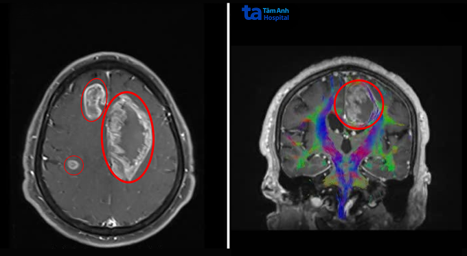 Robot AI giúp bác sĩ mổ ba khối u ở não bệnh nhân 1 Ảnh chụp MRI 3 Tesla ghi nhận ba khối u lớn (khoanh tròn) trong não ông Giang. Ảnh: Bệnh viện Đa khoa Tâm Anh